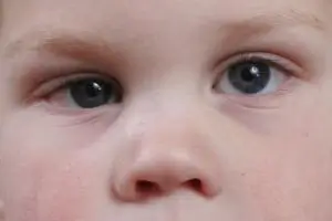 squint-eye-of-children