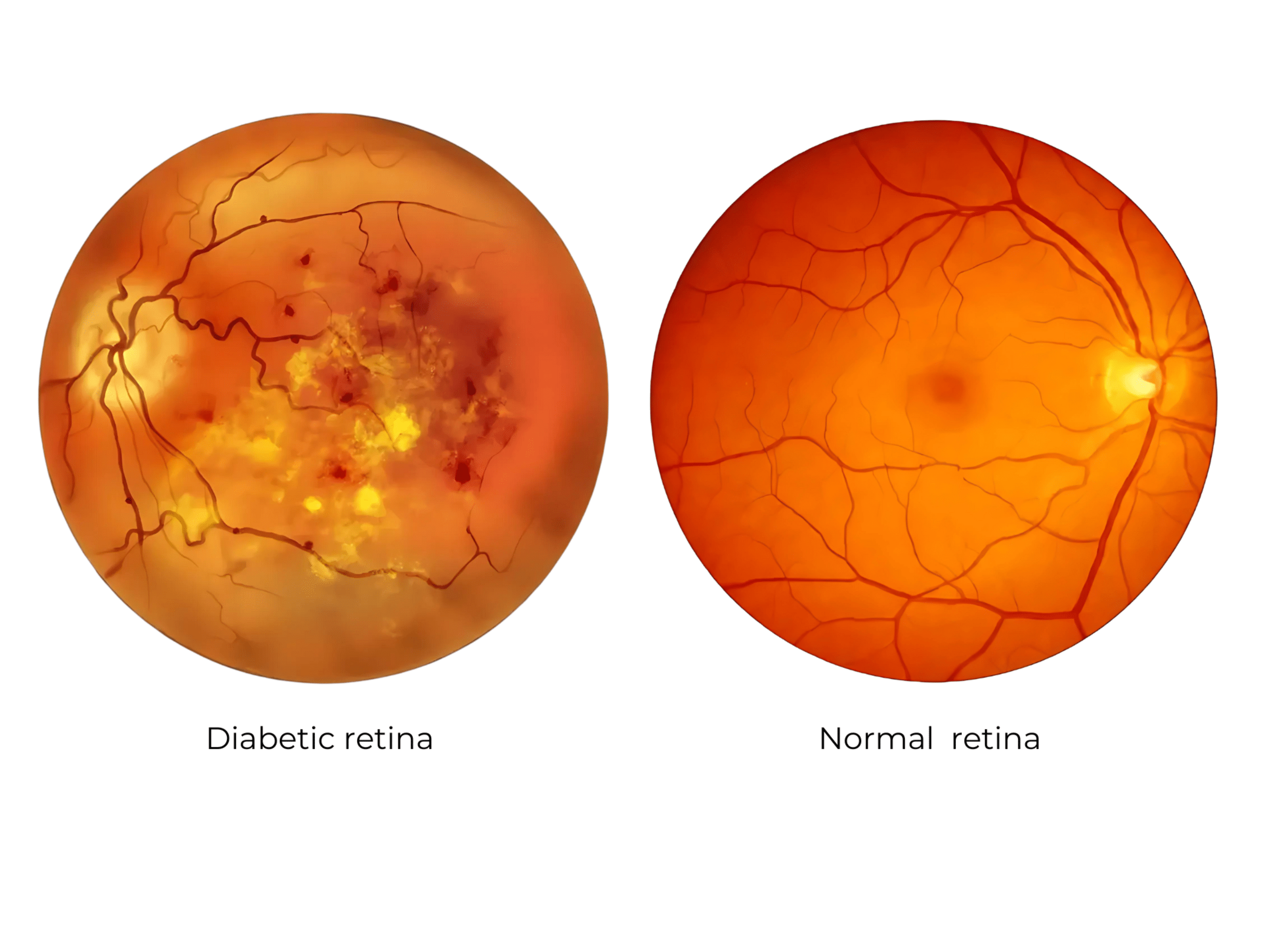 Diabetic Retinopathy