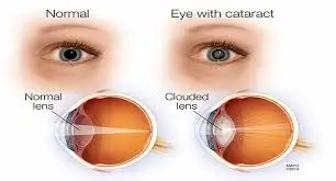 Cataract Hereditary