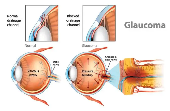 Glaucoma Heridity