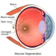 Mascular Degeneration